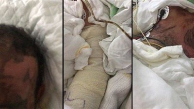 بسبب السحر.. زوجة تحرق زوجها بماء النار