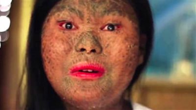 وراثي وغير معد.. ما لا تعرفه عن مرض جلد السمكة