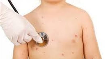 8 خطوات لحماية طفلك من الإصابة بالالتهاب السحائي المميت