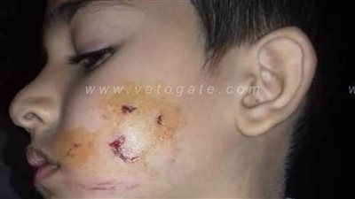 كلب ضال يعقر تلميذا بكفر شكر بالقليوبية | صور