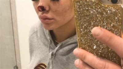 شاب يأكل أنف حبيبته ويضرب رأسها في المرحاض بسبب الغيرة