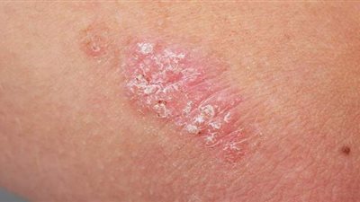 تعرف على مرض الصدفية.. أسبابه وطرق العلاج