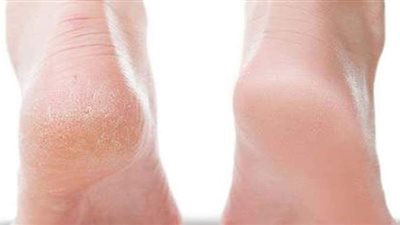 علاج تشقق القدمين.. طرق فعالة وسهلة