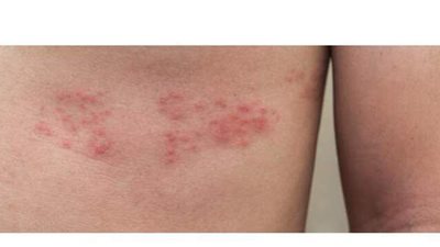 مرض الحزام الناري.. الأسباب والأعراض وطرق العلاج