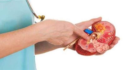 أعراض حصوات الكلى