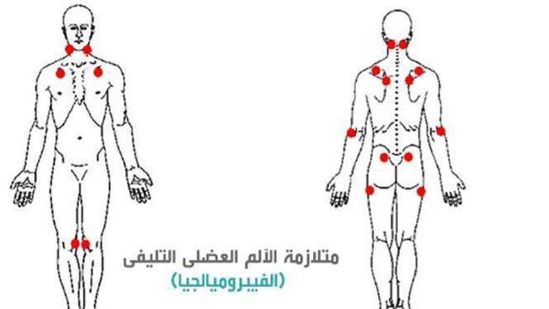 مرض اللص الخفي فيبروميالجيا