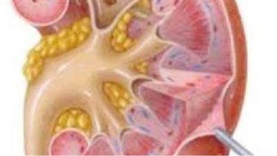 علاج حصوات الكلى