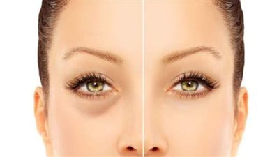 قبل العيد.. تخلصي من انتفاخات العين بخلطات طبيعية سريعة المفعول