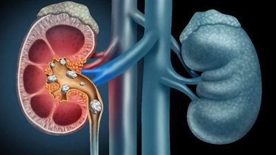 علاج حصوات الكلى بالخضراوات الطازجة