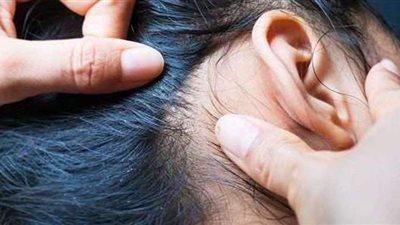 علاج القمل فى الشعر