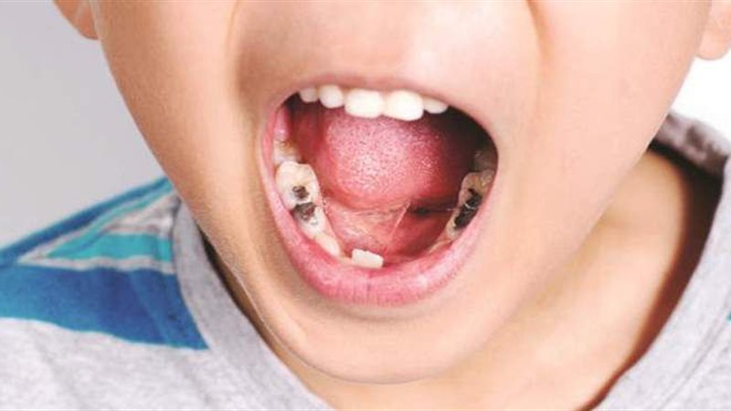 تسوس أسنان الأطفال