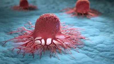 علاج جديد لمرض السرطان بدل من الكيماوي والإشعاع