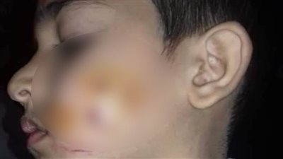 بعد إصابة طفلين.. حملة للقضاء علي الكلاب الضالة بكفر شكر