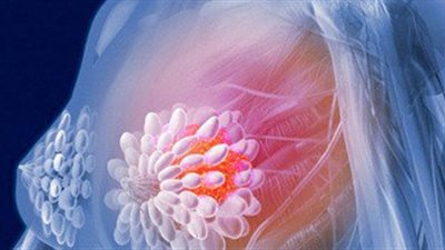 الاختبارات الجينية تسمح باكتشاف التحور في الجين المسئول عن السرطان