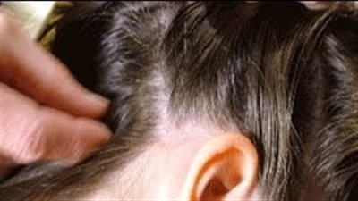 بالفيديو.. نصائح تحمي طفلك من «قمل الرأس» خلال الدراسة