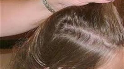 6 نصائح تحمي طفلك من «القمل» في موسم المدارس