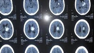 الأشعة المقطعية على المخ تكشف احتمالات الإصابة بالاكتئاب