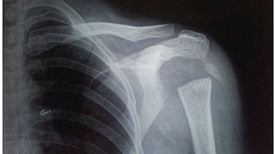 امرأة تستطيع إدارة ذراعيها للخلف بزاوية 180 درجة (صور)