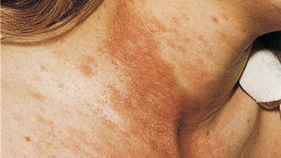 «استشاري جلدية» يشرح أسباب «تصبغ الجلد» وطرق علاجها
