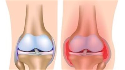بالفيديو..عصير سحري يخلصك من آلام المفاصل والالتهابات نهائيا