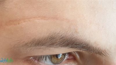 التاتو الطبي لإخفاء الندبات الجراحية