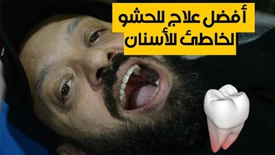 بالفيديو.. أفضل علاج للحشو الخاطئ للأسنان