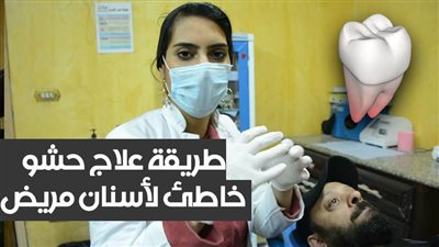 بالفيديو.. طريقة علاج حشو خاطئ لأسنان مريض