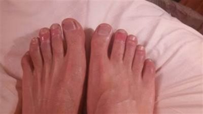 كل ما تريد معرفته عن مرض عضة الصقيع وتورم الأصابع في الشتاء