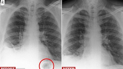 بالصور.. اشتباه إصابة رجل بالسرطان يكشف سر عمره 40 عاما