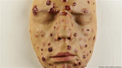 مرض الزهري الجنسي يعود من جديد.. وهذه طرق علاجه