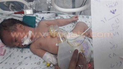 بالصور.. نجاح أول عملية لإعادة الحجاب الحاجز لرضيع بمستشفى بورسعيد