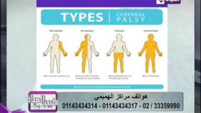 بالفيديو.. أنواع إصابة عظام المخ