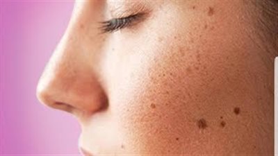 أفضل وصفة طبيعية لإزالة البقع الداكنة من البشرة (فيديو)