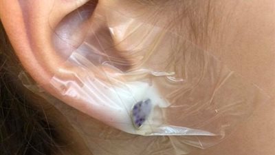 قرط يخترق أذن طفلة  بعد تركيبه (صور)