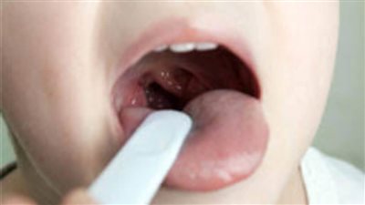 علاج اللحمية خلف الأنف