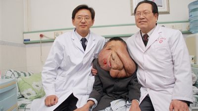 بالفيديو والصور.. إزالة ورم يزن 25 كيلو جراما من وجه رجل صيني