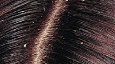 الشوفان الحل الأمثل للقضاء على قشرة الشعر