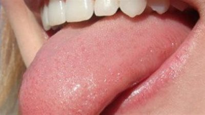 الأسباب الطبية لتغير لون اللسان وطرق علاجها