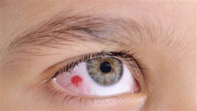 جراح عيون يكشف أسباب وعلاج ظفرة العين