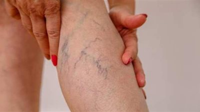 بالريجيم والرياضة..علاج دوالى الساقين