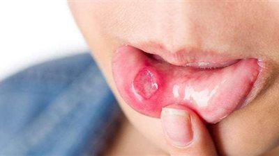 أعراض داء بهجت ومضاعفاته