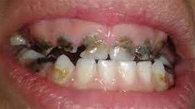 تفسير حلم تسوس الأسنان في المنام وعلاقته بالخيانة والطلاق وحدوث مشاكل للجنين