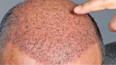 دار الإفتاء توضح حكم الشرع في عمليات زرع الشعر الطبيعي وارتداء الباروكة