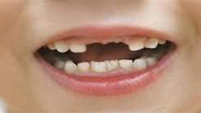 تفسير رؤية سقوط الأسنان في المنام وعلاقته بطول العمر