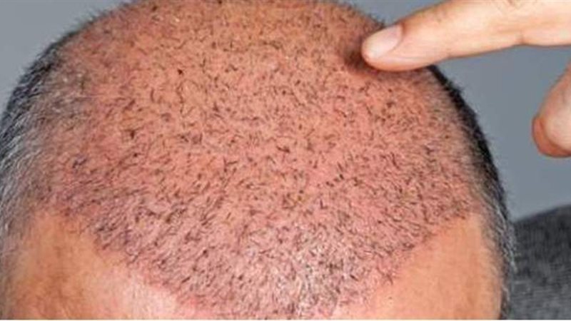 عمليات زرع الشعر