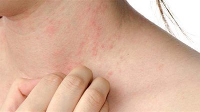 كورونا السبب.. طبيب تجميل يكشف عن انتشار أمراض جديدة للحساسية | فيديو