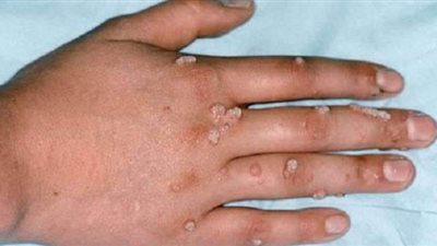 جدري القرود.. أعراضه وأسبابه وطرق العلاج والوقاية
