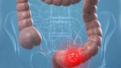 تحذيرات من أورام القولون.. التدخين والمياه الغازية واللحوم المصنعة والتيك أواي «أبرز الأسباب».. والرياضة تساعد في الوقاية