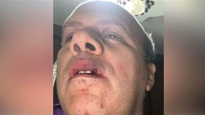 جروح خطيرة وارتجاج بالمخ.. مصدر طبي يكشف الحالة الصحية لرئيس حي عين شمس بعد محاولة قتله