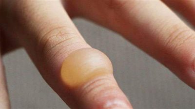 ٦ طرق طبيعية لعلاج الحروق البسيطة